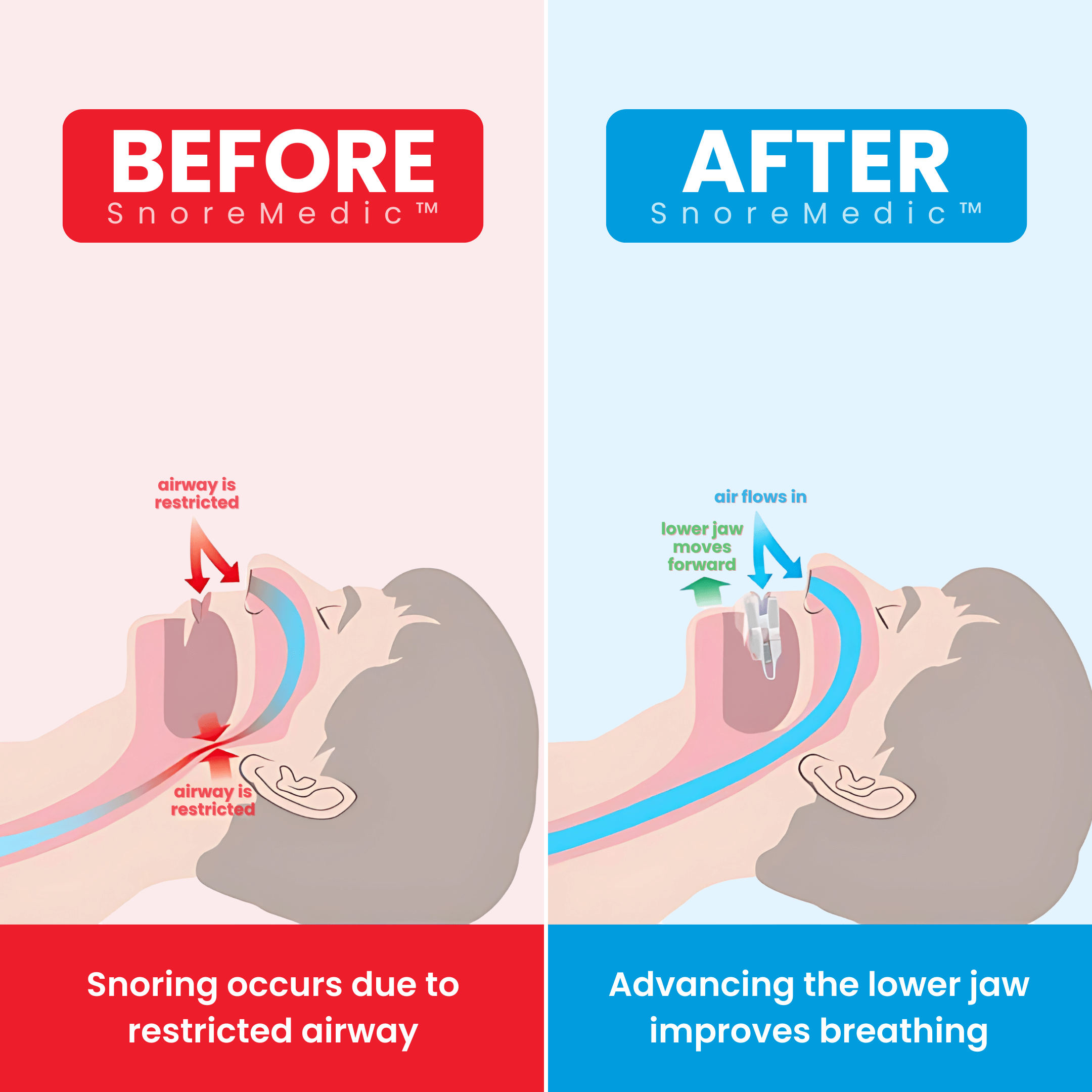 Less Snoring Anti-Snoring Mouth Guard | Stop Snoring with SnoreMedic™ Plus
